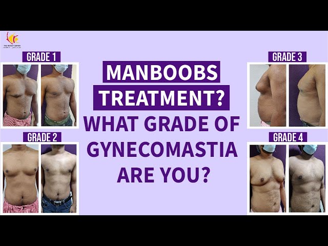 4 grades of Gymecomastia Explained | Mild to moderate to Severe man boobs due to hormonal imbalance
