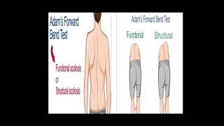 Spine deformities: Scoliosis / Dr. Alaa akel