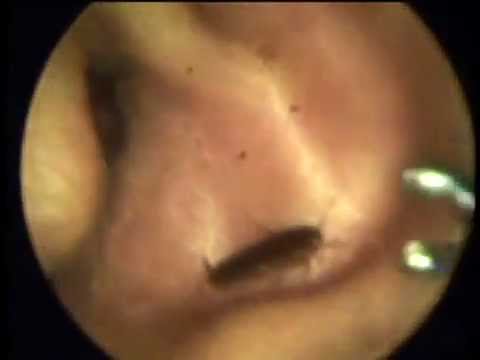 グロ地獄 2 耳の中にゴキブリ ﾟ ﾟ Youtube