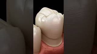Animated Dental Crown Procedure
