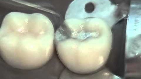 Class II Amalgam Final Restoration