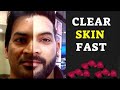 Get Clear & Glowing Skin Faster