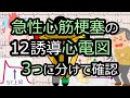 ST上昇の急性心筋梗塞の12誘導心電図は３つ(+1)に分けて考えよう