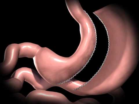Sleeve Gastrectomy - Video Explanation