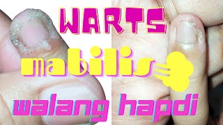 Paano Matanggal Ang Warts O Kulugo Ng Walang Hapdi At Paltos | Amhie Roderos Paano Matanggal Ang Warts O Kulugo Ng Walang Hapdi At Paltos | Amhie Roderos