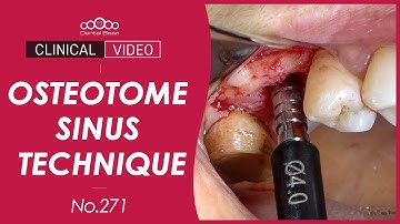 #16 implant placement with Osteotome Sinus Floor Elevation [Dr. Kim Yongjin]
