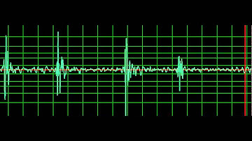 Prosthetic Mitral Valve Closing Click- normal speed