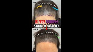 잘 못된 두피 문신 되돌릴 수 있습니다