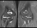 Normal versus partially torn UCL of elbow