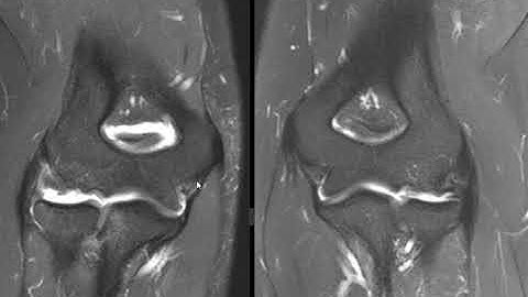 Normal versus partially torn UCL of elbow