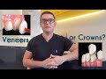 Veneers or Crowns? The Approach of a Turkish Dentist