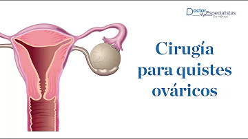 ¿Es la extirpación de un quiste ovárico una cirugía importante?