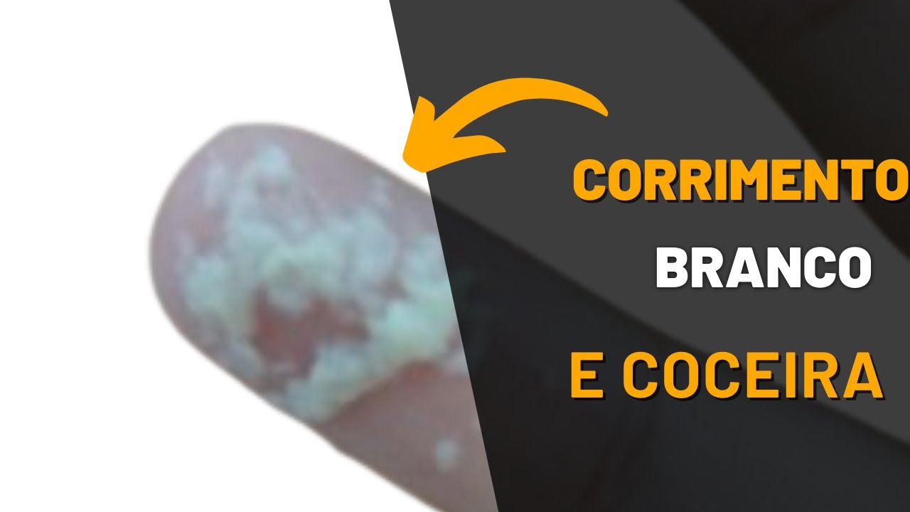 Corrimento branco com coceira / Corrimento branco pastoso / Dra Roberta ...