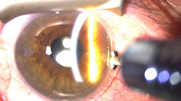 Slit lamp LRI by Steven G. Safran MD