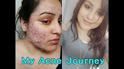 From Severe Acne to Clear Skin