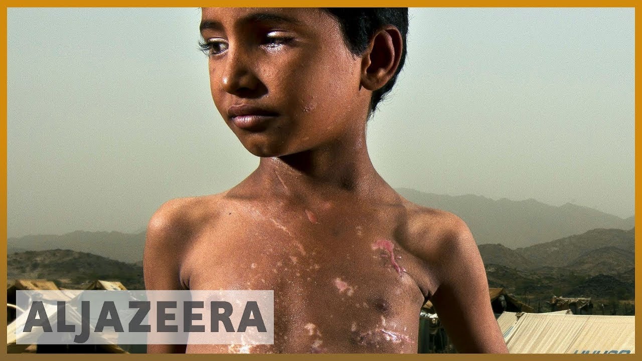حرب اليمن: خسائر فادحة للأطفال | الجزيرة الإنجليزية