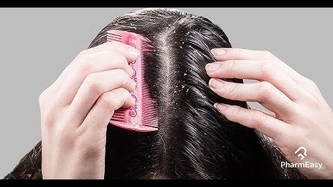 Get Rid of dandruff in 1 Day! _ Instant Dandruff Remedy at Home