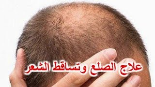علاج الصلع نهائيا⁦️⁩الوصفة المعجزة لإنبات الشعر وصفة مجربة 100%
