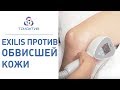 🔬Безоперационная подтяжка кожи тела с помощью процедуры EXILIS. Безоперационная подтяжка кожи. 12+