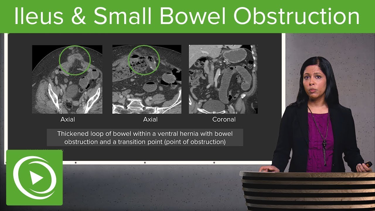 Bowel Obstruction and Ileus: Ileus & Small Bowel Obstruction – Radiology | Lecturio