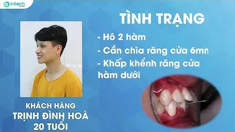 THẤY SỰ THAY ĐỔI CHỈ SAU 6 THÁNG NIỀNG RĂNG HÔ