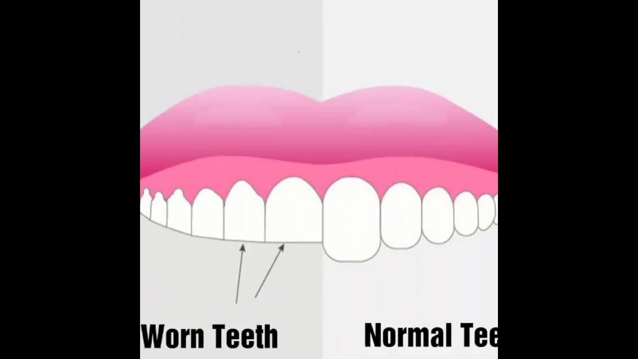 Teeth Grinding & Cosmetic dentistry حف الاسنان و العلاج YouTube