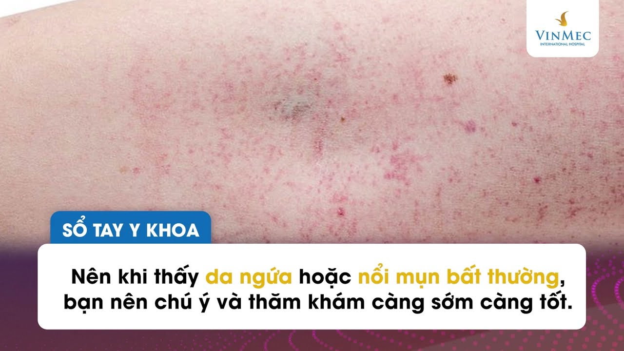 Những Dấu Hiệu Cảnh Báo Bệnh Gan Và Cách Chăm Sóc Sức Khỏe Gan Của Bạn