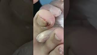 ingrown toenail treatment