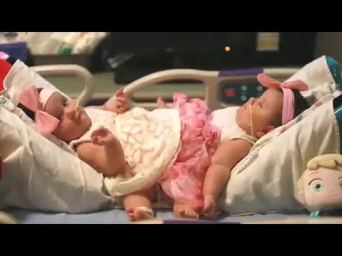 Formerly conjoined twin sisters defy the odds