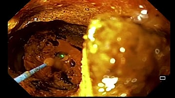 Holmium laser lithotripsy for large CBD stone inside CBD using regular upper endoscoy