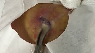 Draining a Pilonidal Cyst on the Gluteal Cleft - Max Poling PA-C