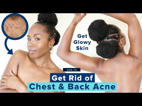 Summer Glowy Skincare Routine | Get Rid of Chest & Back Acne, Boils & Cysts | Affordable & Cheap