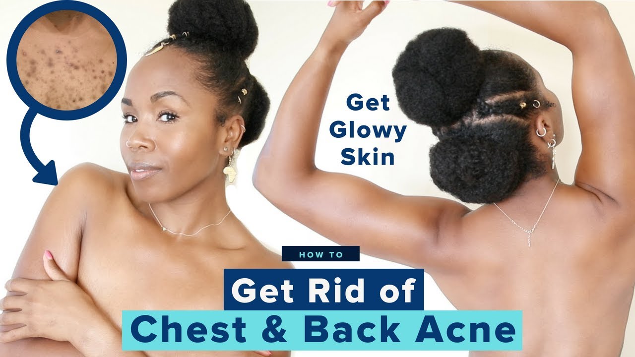 Summer Glowy Skincare Routine | Get Rid of Chest & Back Acne, Boils & Cysts | Affordable & Cheap