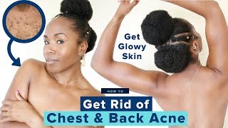 Summer Glowy Skincare Routine Get Rid Of Chest & Back Acne, Boils & Cysts Affordable & Cheap