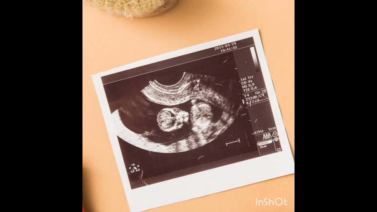 7 week pregnancy | Ultrasound scan |yolk sac# learn more