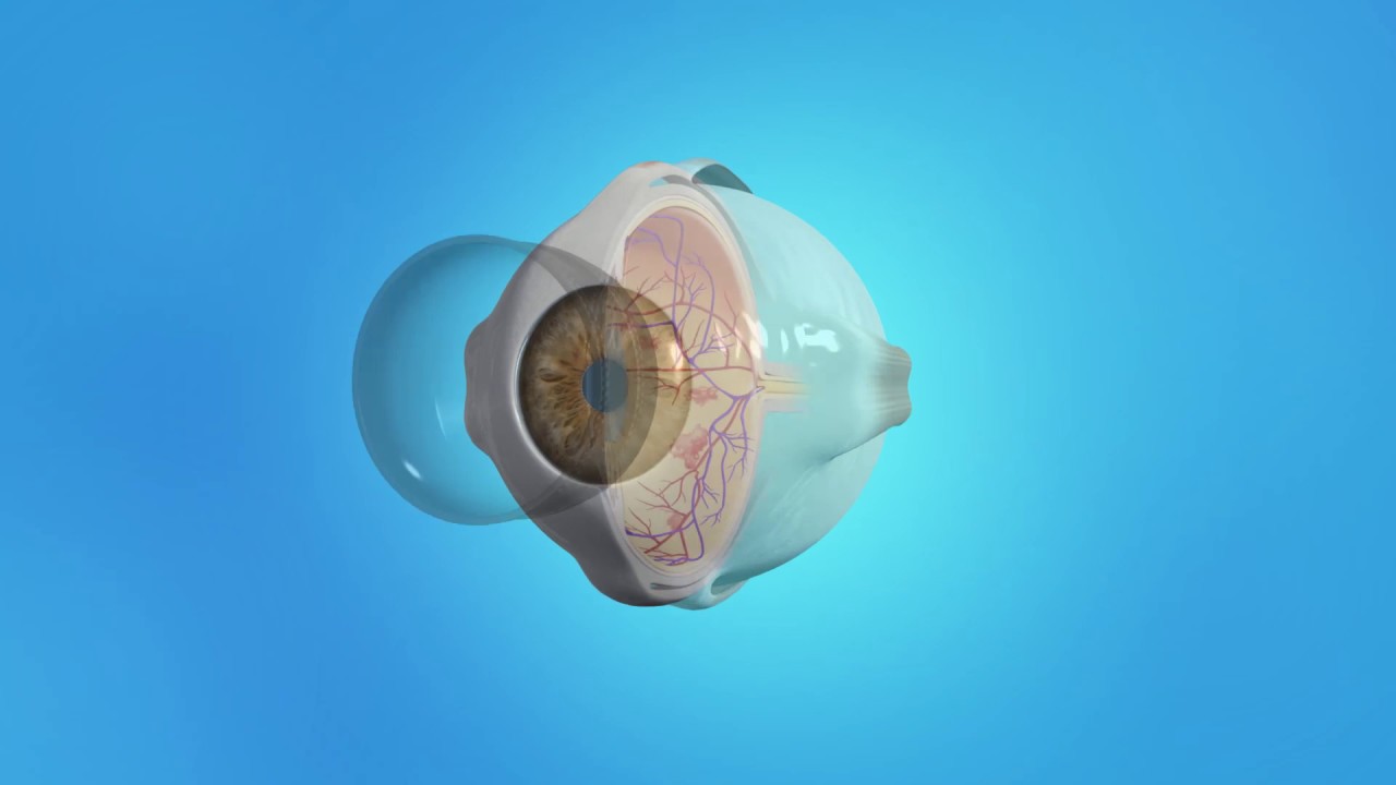 Retina Diabetic PDR Laser Spanish YouTube