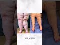 Consistent Great Results for Lipedema #lipedemaawareness #patientcare