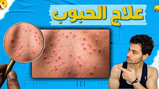 ازاي تتخلص من الحبوب تماما (جميع طرق علاج حب الشباب ومشاكل البشره والجلد)