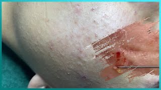 Big Cystic Acne Blackheads Extraction Blackheads & Milia, Whiteheads Removal Pimple Popping