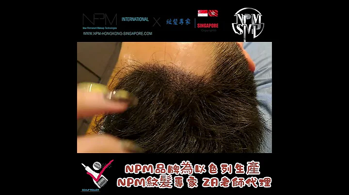 NPM纹发奇蹟：30分钟解决M字额后移，重新塑造完美发际线！ - 天天要闻