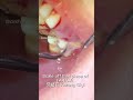 What Is Dental Scaling 洗牙都在洗些什麼 Penskaleran Gigi Shorts Shortsfeed What Is Dental Scaling 洗牙都在洗些什麼 Penskaleran Gigi Shorts Shortsfeed