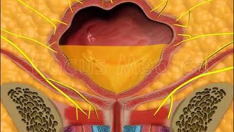 Complications of overactive bladder - Animated Atlas of BPH and OAB