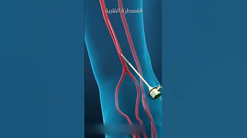 قسطرة القلب القسطرة القلبية 
