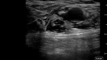 Axillary brachial plexus block