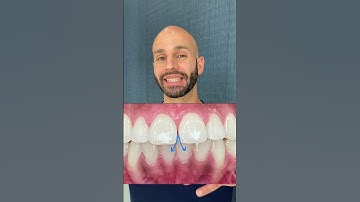 How we plan to close this space with Invisalign and WHY