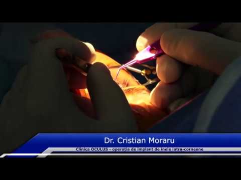 Dr. Cristian Moraru - Operatie de implant de inele intra-corneene cu tehnologia femtoLaser