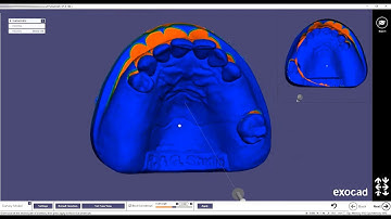 8- LIVE Design of a partial framework and printing process with the METAL PRINTER Shining 3D EP-M150