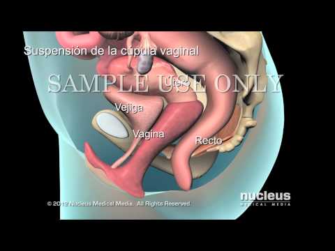 Vídeo: Reparo Anterior Da Parede Vaginal