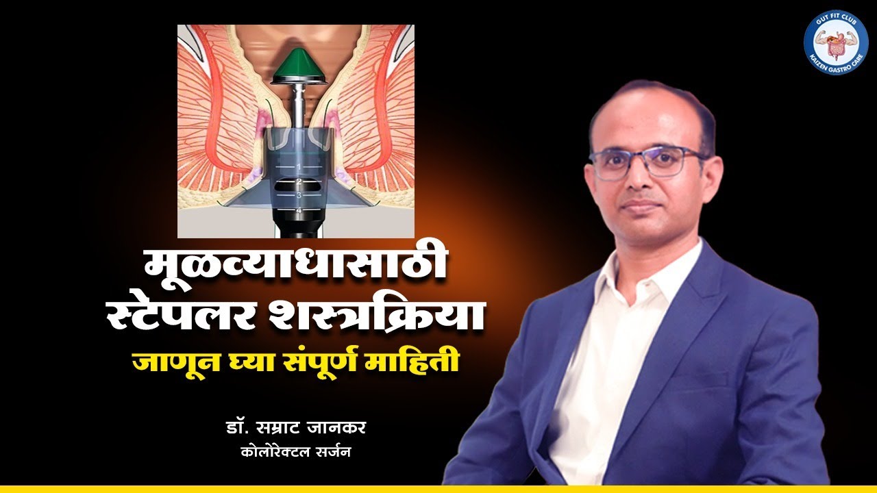 मूळव्याध (Piles)Modern Solution-Stapler Surgery | Stapler Surgery For Piles|Stapler Hemorrhoidectomy