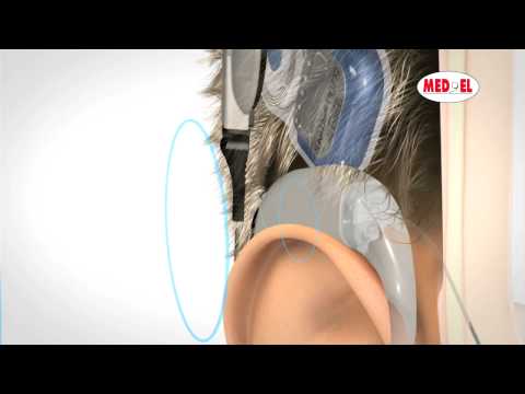 The MAESTRO Cochlear Implant Video for Different t...